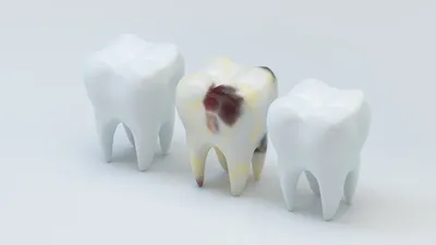 What Brown Stains on Teeth Mean