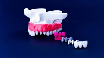 Veneers vs Crowns