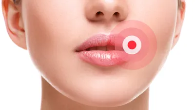 Stomatitis: Causes, Symptoms, and How to Treat Mouth Inflammation