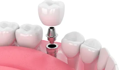 What Is Restorative Dentistry?