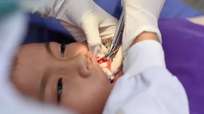 Tooth Extraction Cost