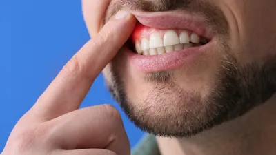 Why Are My Gums Black?