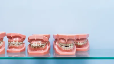 What Are Pacifier Teeth?