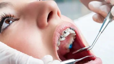 How Long Do Braces Hurt?