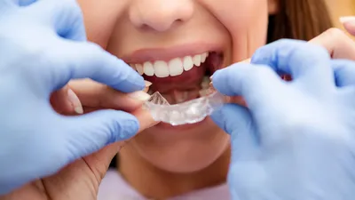 The 4 Cheapest Clear Aligners (2026)