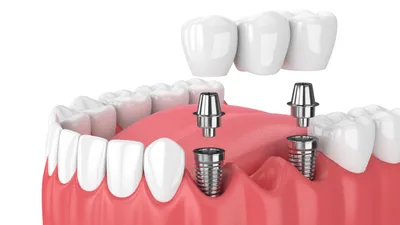 Types of Dental Bridges & Procedure Steps