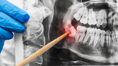 Impacted Wisdom Teeth: Symptoms, Diagnosis & Treatment