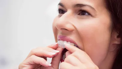SLX Clear Aligners Review