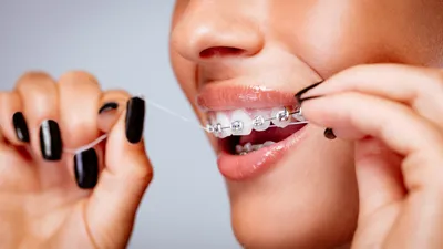 How to Floss With Braces (Step-by-Step)