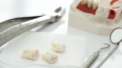 How Much Does Wisdom Tooth Removal Cost?