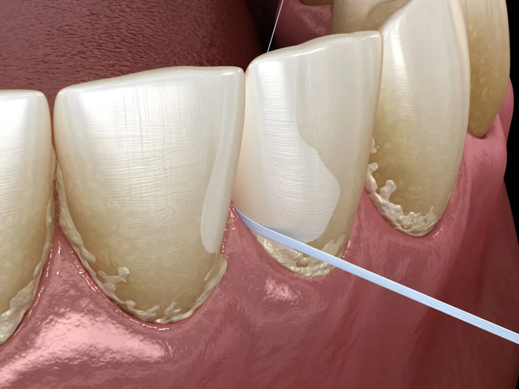 3D render of an example of ral hygiene of sing dental floss for plaque removing