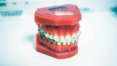 Overbites: Causes, Complications & How To Fix Them