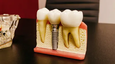 What is a Single Tooth Implant?