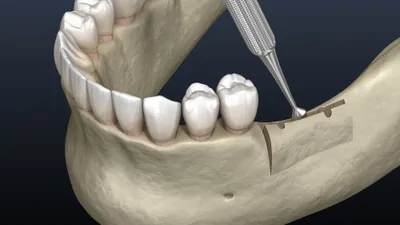 What Is An Alveoloplasty?