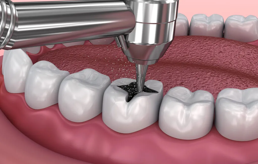 3d render of cavity filling procedure 1