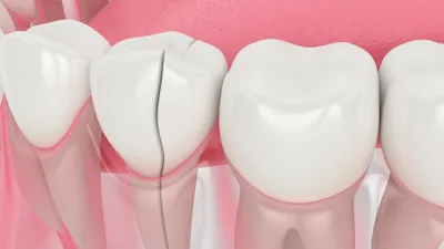 Cracked Teeth: 5 Types of Tooth Fractures