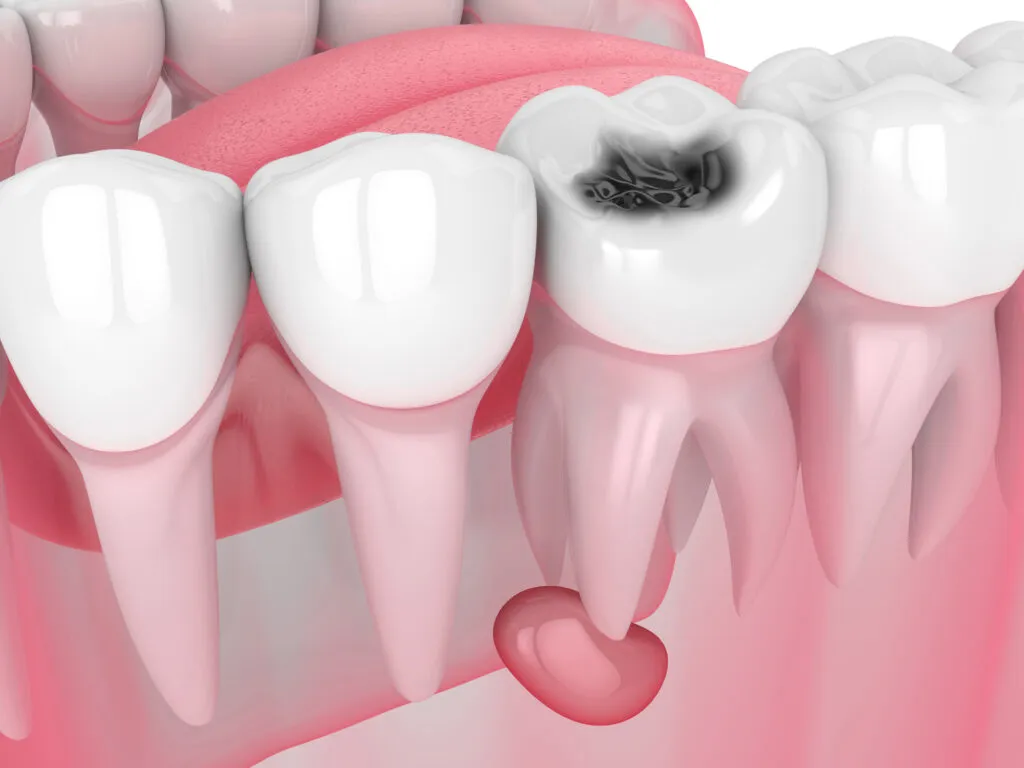 3d render of jaw with tooth cavity and cyst or dental pulp