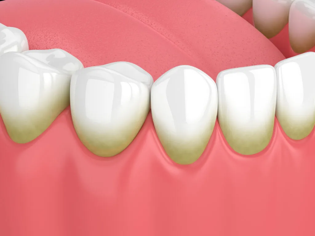 Brown Stain on the lower part of teeth and borderline of the gums due to dental problems