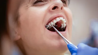 Six Month Smiles Aligners Review (2026)