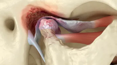 TMJ Surgery: Types, Costs, What to Expect, Procedure, and Recovery