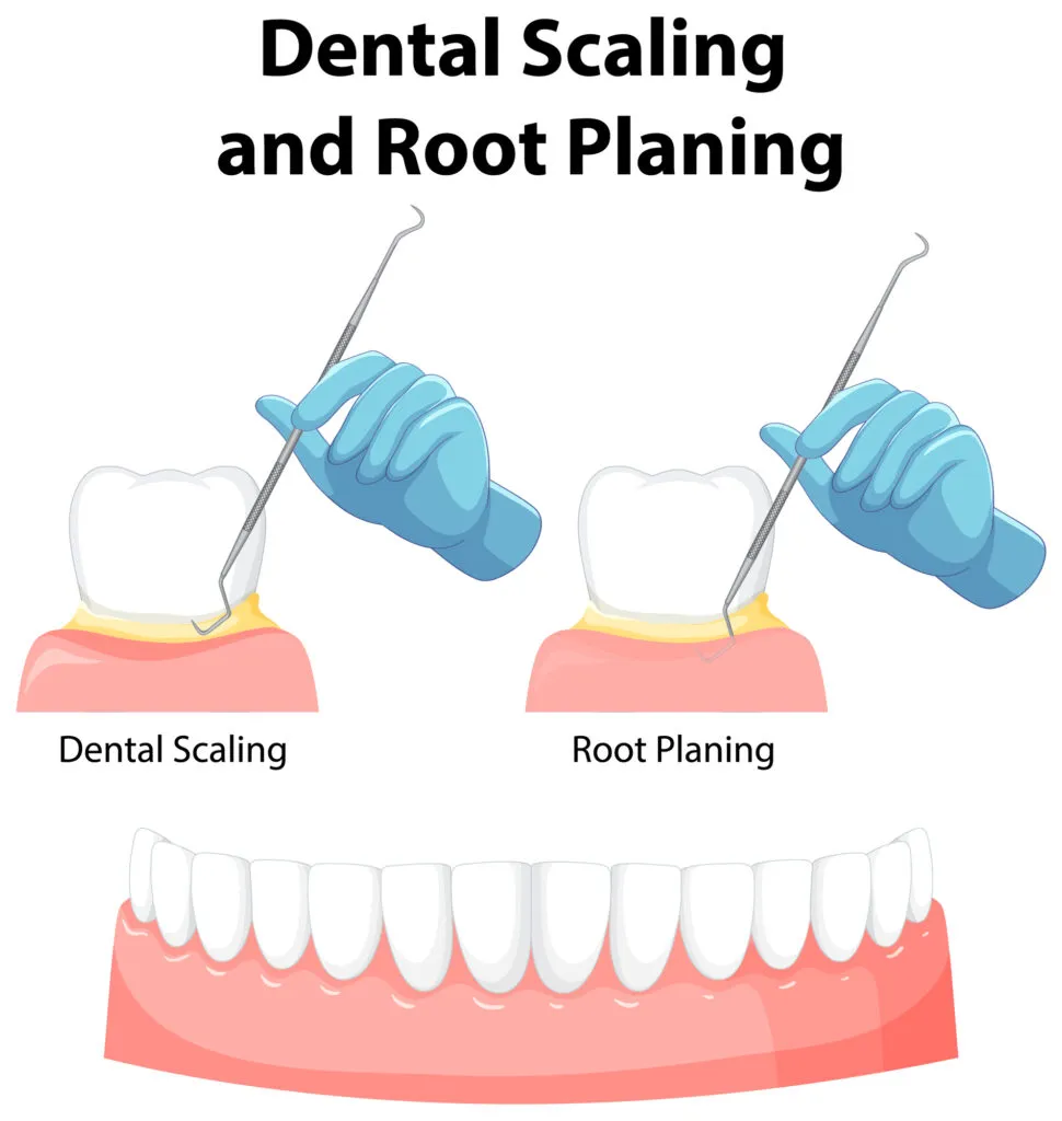Infographic of human in dental scaling and root planing illustration