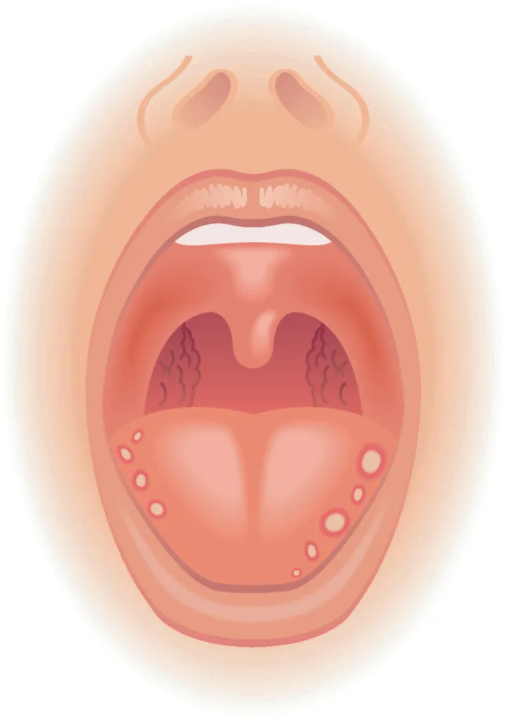 Medical illustration of symptoms of tongue sores