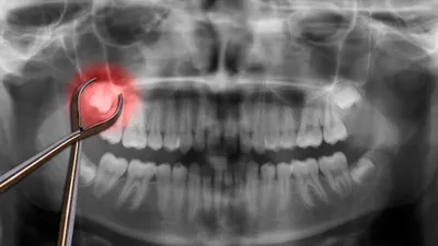 Can Wisdom Teeth Grow Back?