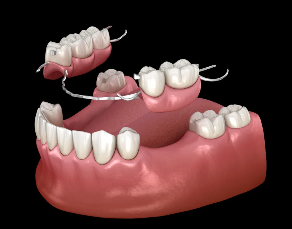 Removable partial denture mandibular prosthesis or dental flippers