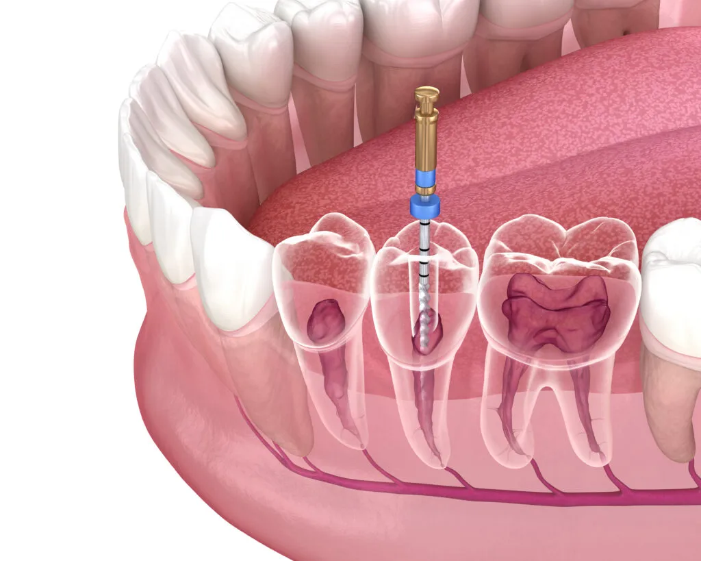 render of root canal