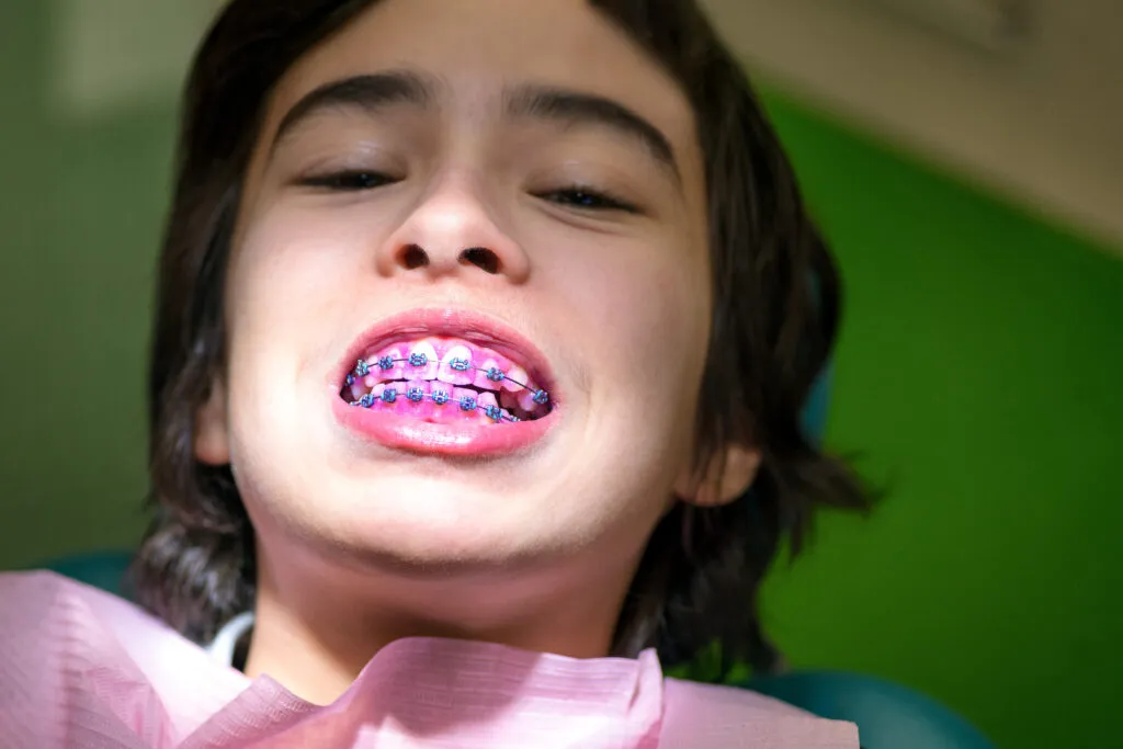 Shot of male kid looking down with colorful braces lit up by light