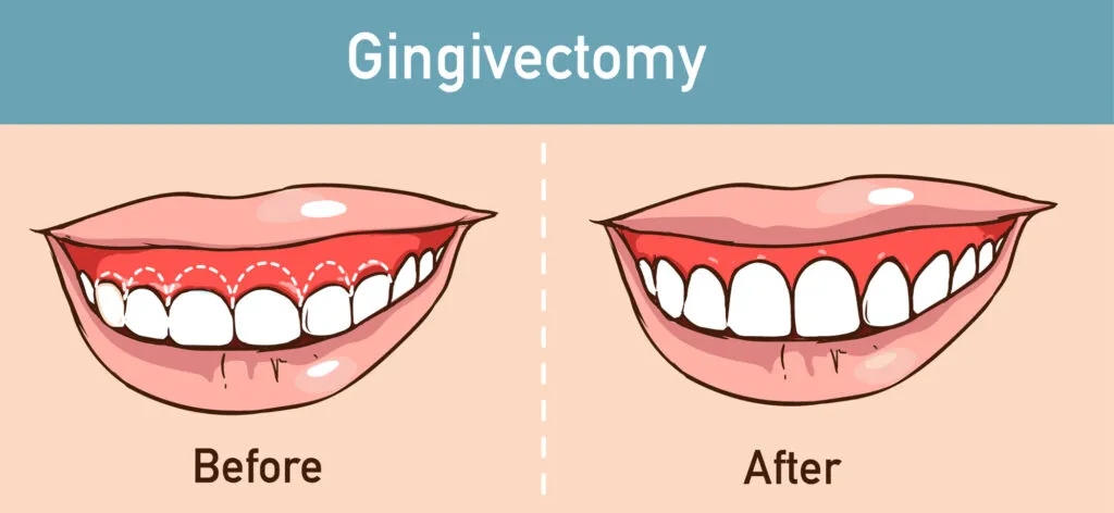 Vector illustration of a before and after comparison of Gingivectomy