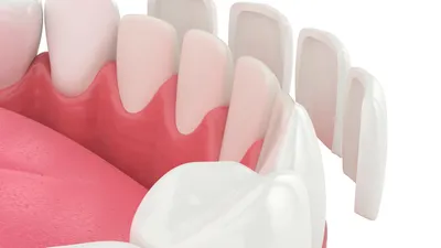 How Much Veneers Cost & Ways to Pay for Them