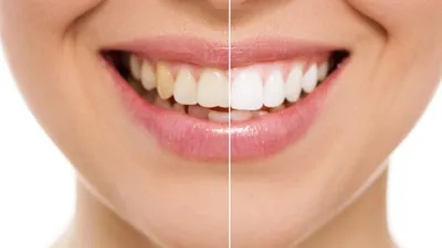 Teeth Whitening Costs
