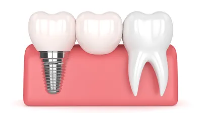 What You Need to Know About Dental Bonding