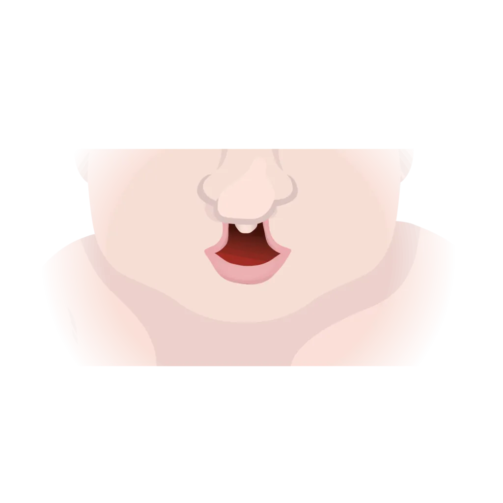 Cleft lip and palate 03