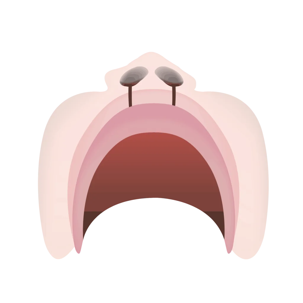 Cleft lip and palate 07