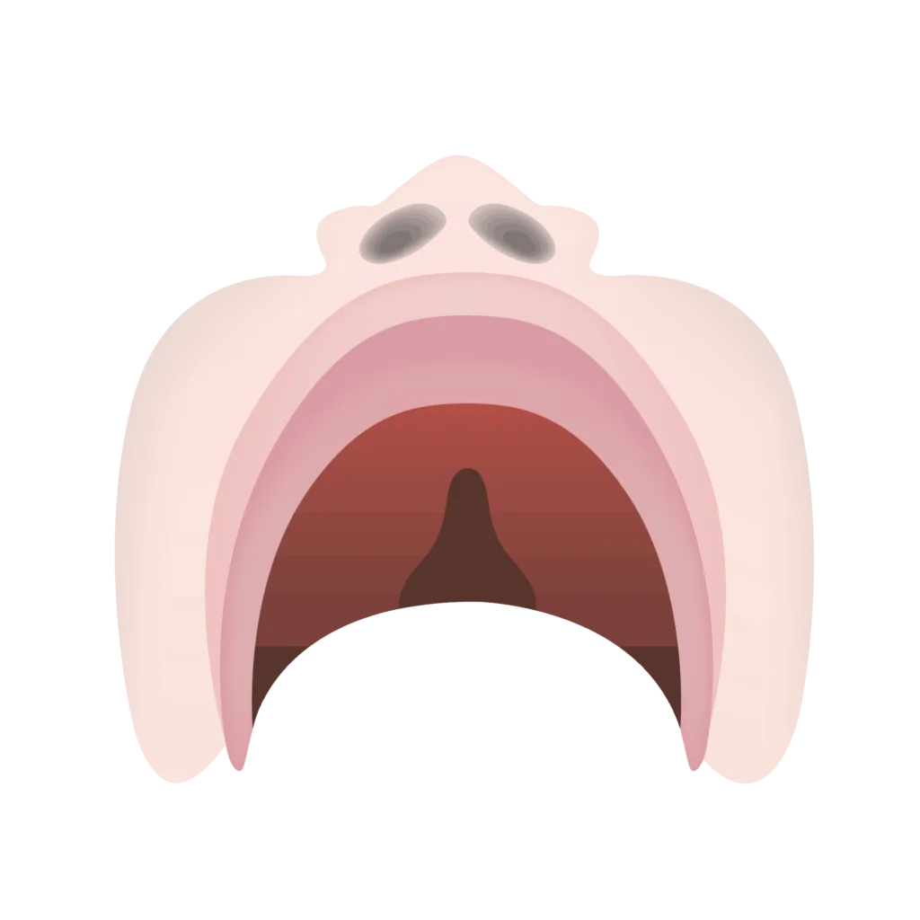 Cleft lip and palate 08
