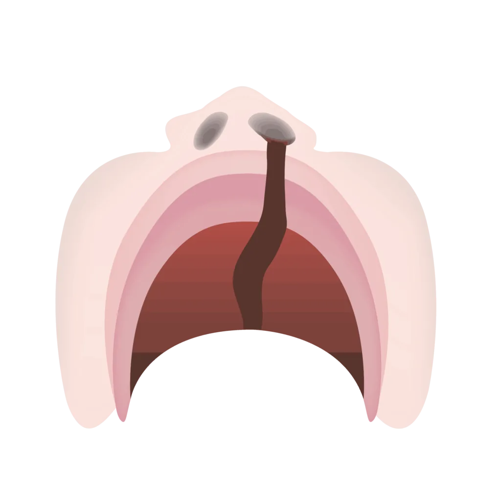 Cleft lip and palate 09