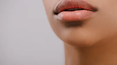 Granulomatous Cheilitis