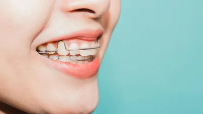 What Should You Do If You Lose Your Retainers?