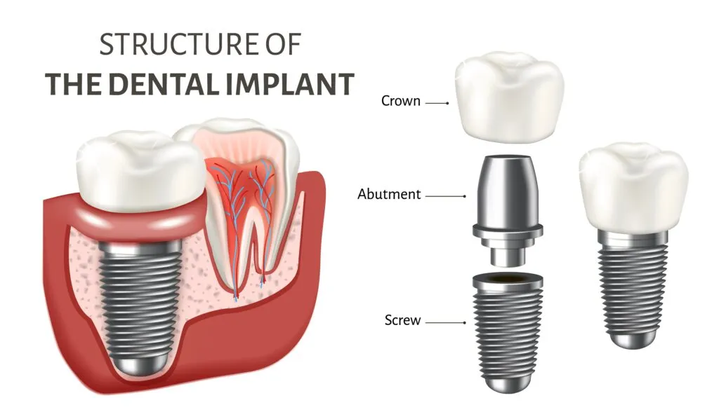 Dental implant
