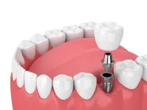 Dental implant NewMouth