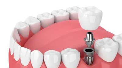 Types of Dental Implants & How They Work
