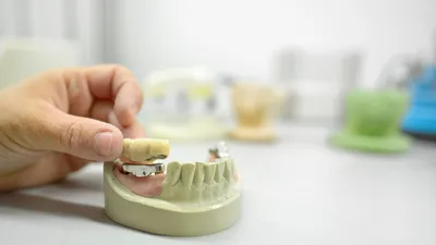 3 on 6 Dental Implants