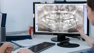 Types of Bone Grafts, Complications & Risks