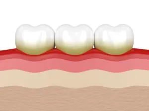 Gum disease NewMouth
