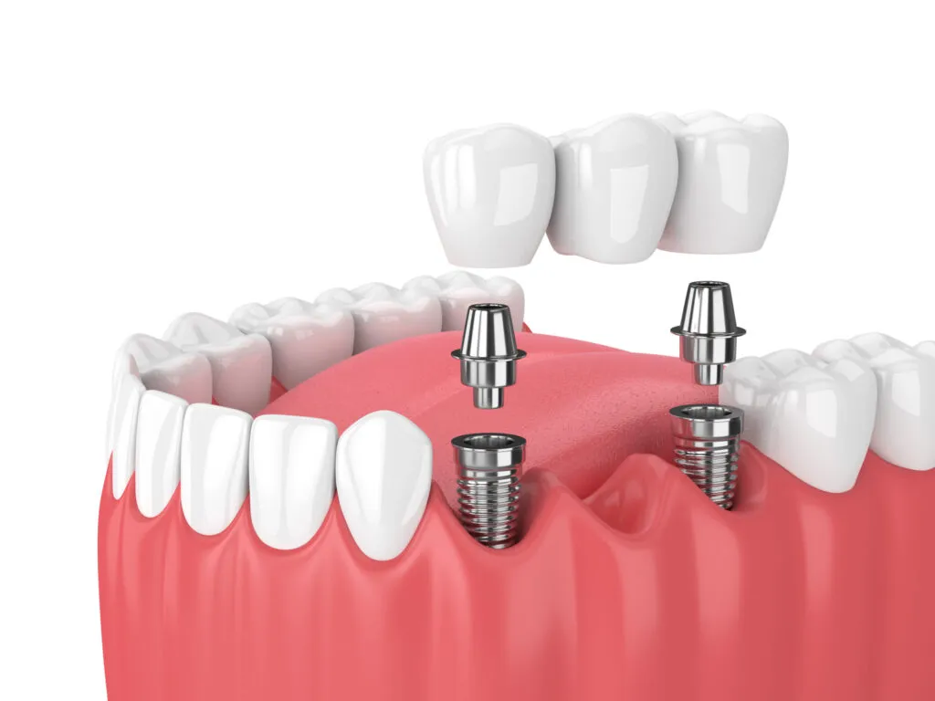 Implant supported bridge NewMouth scaled 1
