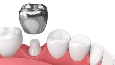 What to Know About Dental Crowns