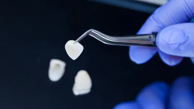 Are Veneers Covered by Insurance?