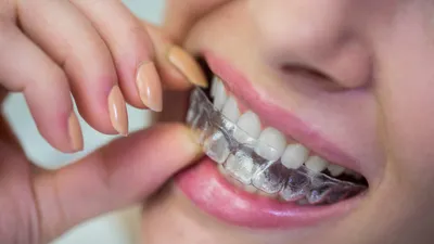 Can Invisalign Fix an Excessive Overbite?
